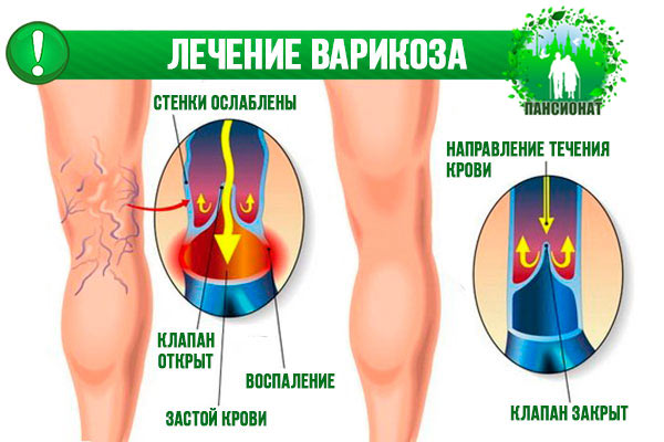лечение варикоза на ногах
